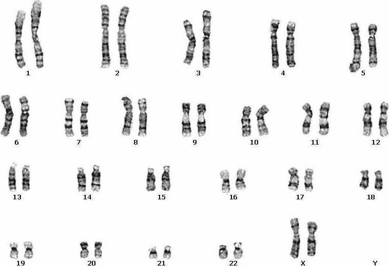 sickle cell anemia karyotype
